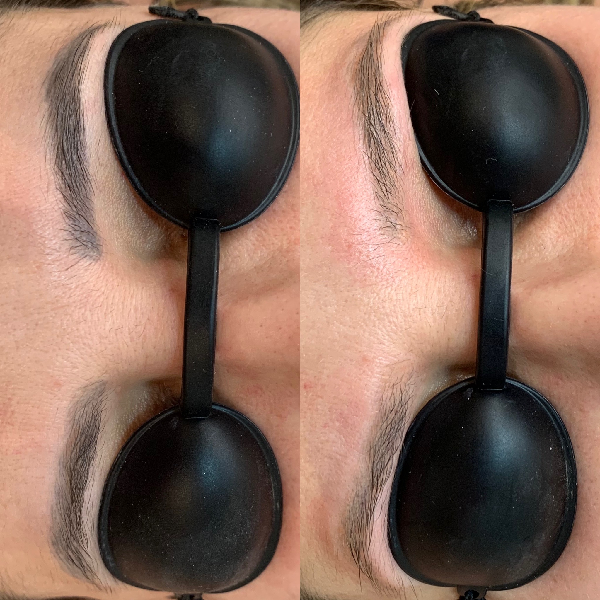 Resultado de remoção a laser